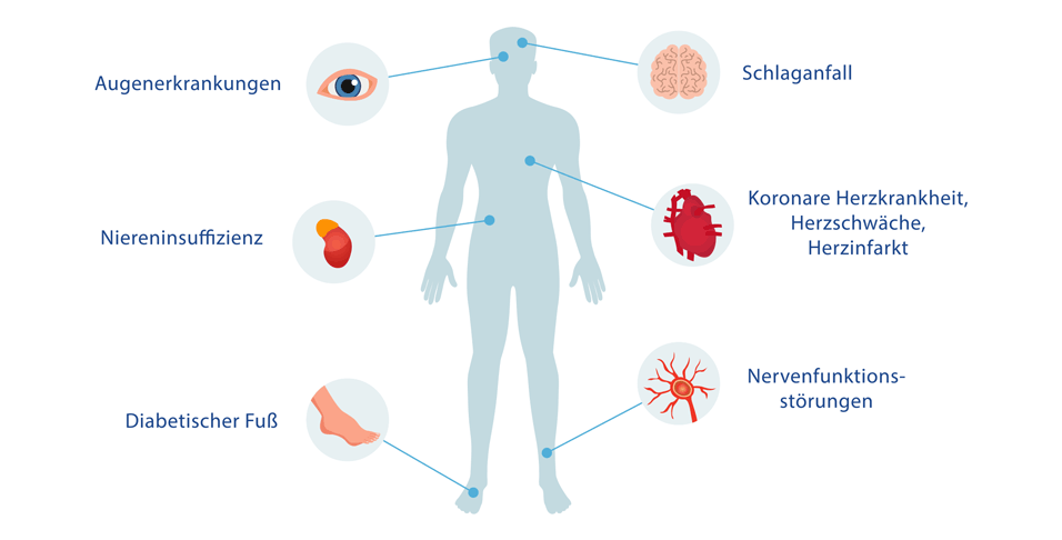 Grafik zu Diabetes-Folgeerkrankungen: Augenerkrankungen, Schlaganfall, Niereninsuffizienz, koronare Herzkrankheit, Herzschwäche, Herzinfarkt, diabetischer Fuß und Nervenfunktionsstörungen.